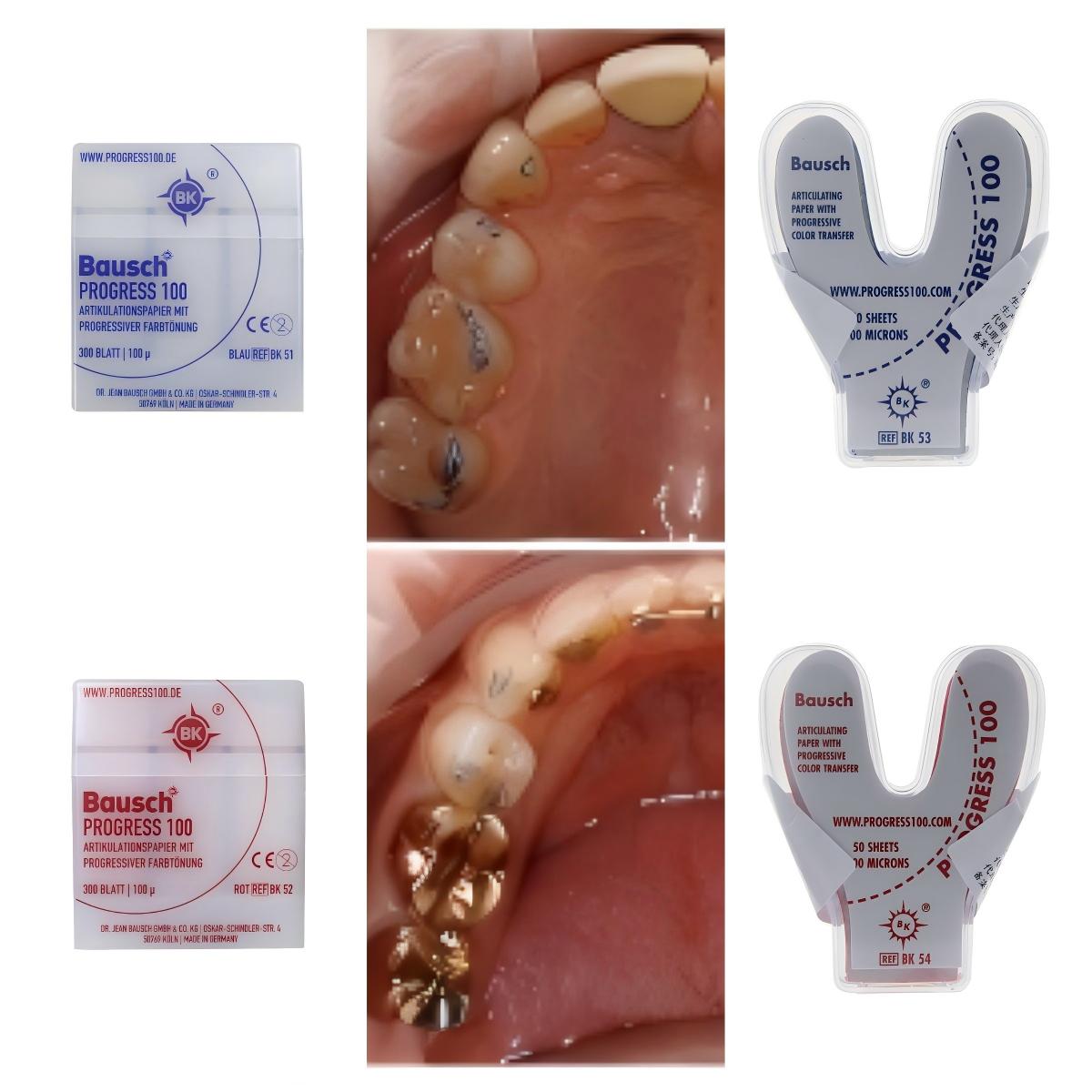Bausch BK51 BK52 BK53 BK54 Den - Bite Indicator ulasan dan harga